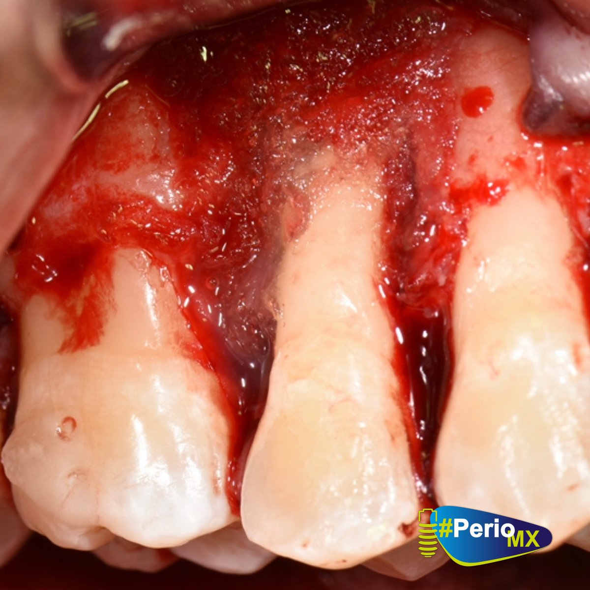 DrMonteagudo's tweet photo. Caso clínico de un paciente con menos 30 años en el que el temor era perder la dentición. La motivación y el uso correcto de la biotecnología de materiales pudo hacer la diferencia. Aquí utilizamos:
✔️Amelogeninas
✔️Hueso alogenico #Grafton
✔️Matriz dérmica acelular #Alloderm https://t.co/B5kKugXvMF
