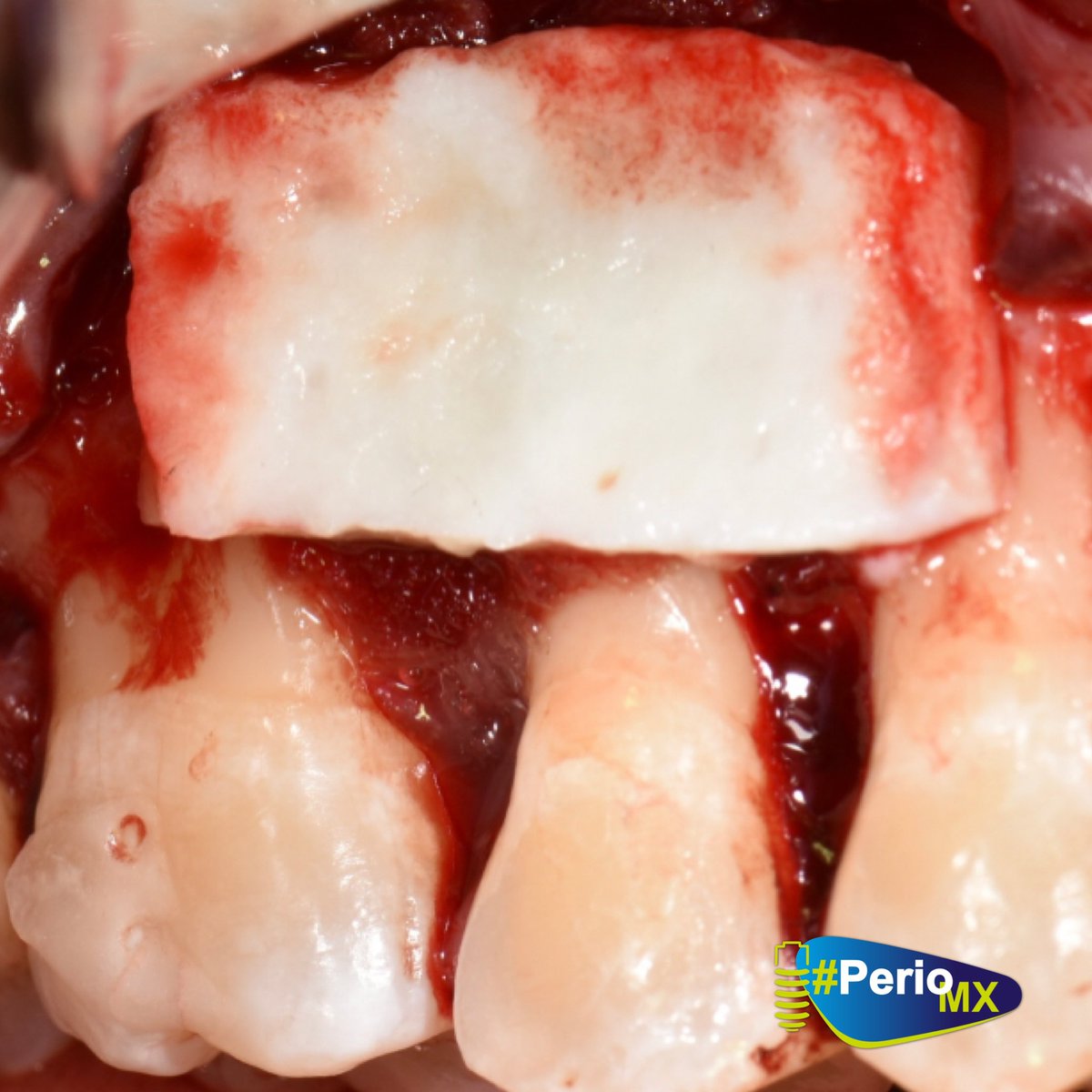 DrMonteagudo's tweet photo. Caso clínico de un paciente con menos 30 años en el que el temor era perder la dentición. La motivación y el uso correcto de la biotecnología de materiales pudo hacer la diferencia. Aquí utilizamos:
✔️Amelogeninas
✔️Hueso alogenico #Grafton
✔️Matriz dérmica acelular #Alloderm https://t.co/B5kKugXvMF