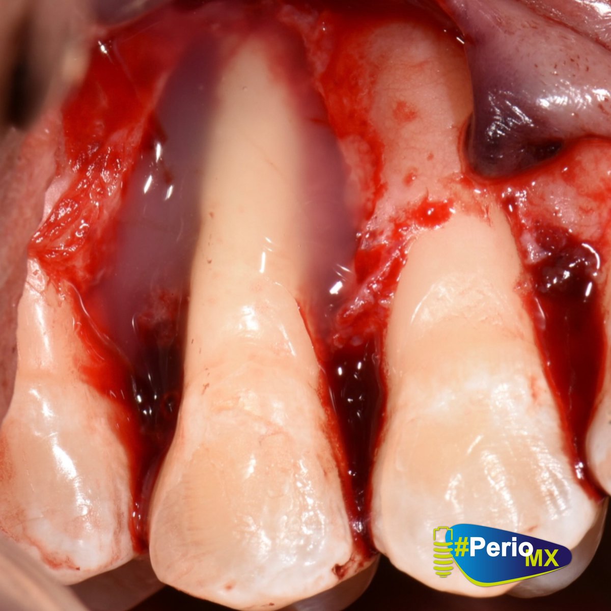 DrMonteagudo's tweet photo. Caso clínico de un paciente con menos 30 años en el que el temor era perder la dentición. La motivación y el uso correcto de la biotecnología de materiales pudo hacer la diferencia. Aquí utilizamos:
✔️Amelogeninas
✔️Hueso alogenico #Grafton
✔️Matriz dérmica acelular #Alloderm https://t.co/B5kKugXvMF