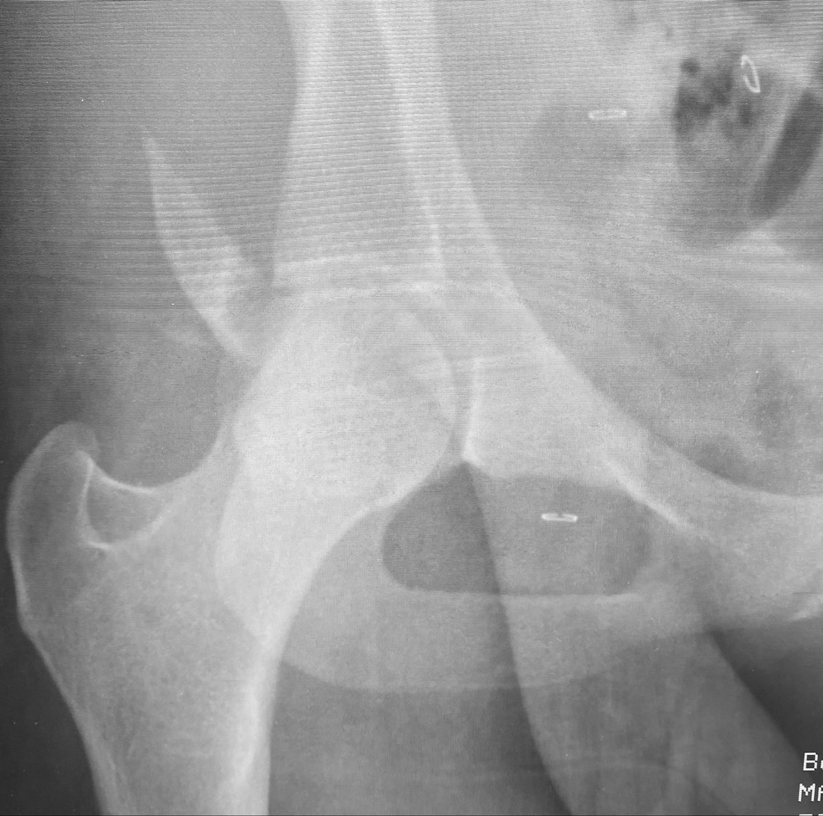 ChipRoutt's tweet photo. Once the obstructing PW fracture fragment is displaced away from the joint, the traction is relaxed and the femoral head can settle into the intact acetabulum - open removal and definitive ORIF are not always possible acutely depending on numerous clinical factors https://t.co/cND4SZQXAh