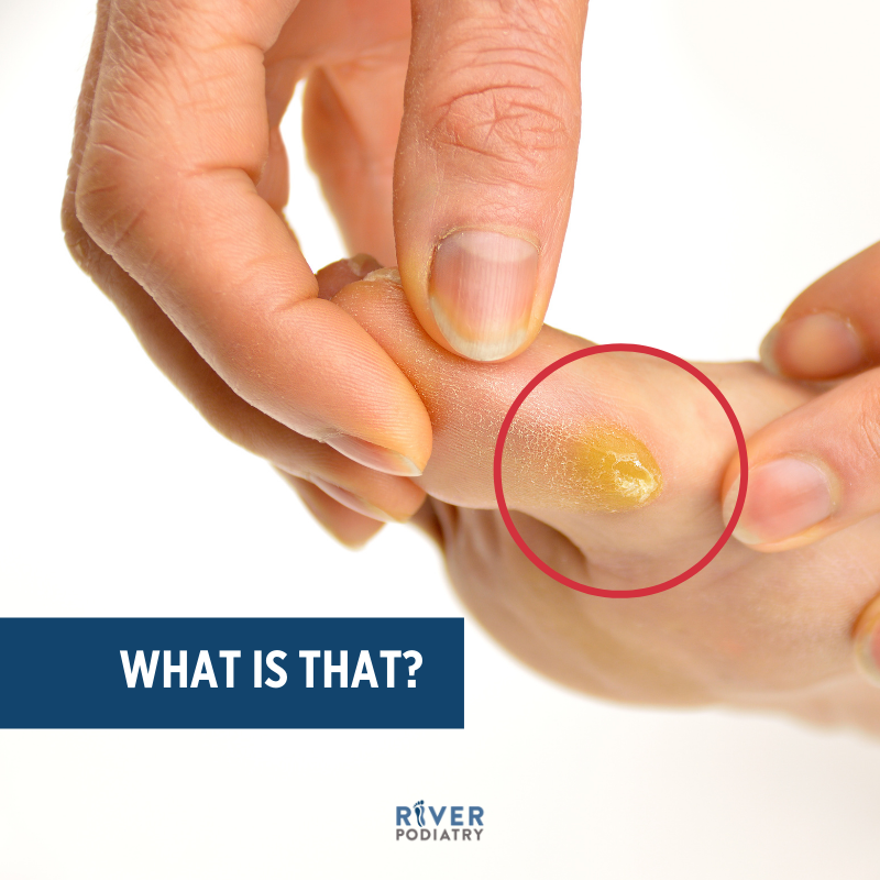 River_Podiatry's tweet photo. If you guessed a "callus", you were right! 

Click the link below to speak with our team.

https://t.co/rvb6q9AV98 https://t.co/b0t8imDl3v