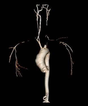 MayoVascSurgery's tweet photo. 28 year old woman with burned out stage 3 Takayasu's Arteritis refractory to medical management.  Ascending aorta to bilateral internal carotid bypass with reimplantation of dominant right vertebral artery. https://t.co/fJI7vJe8DO