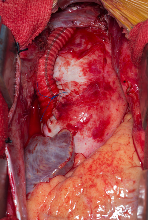 MayoVascSurgery's tweet photo. 28 year old woman with burned out stage 3 Takayasu's Arteritis refractory to medical management.  Ascending aorta to bilateral internal carotid bypass with reimplantation of dominant right vertebral artery. https://t.co/fJI7vJe8DO
