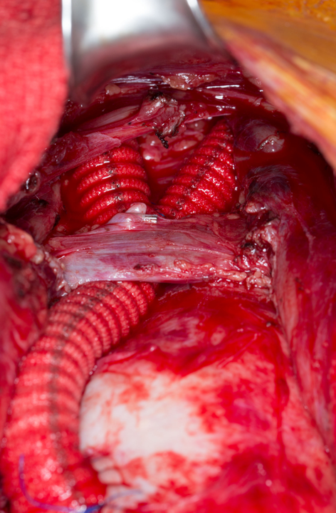 MayoVascSurgery's tweet photo. 28 year old woman with burned out stage 3 Takayasu's Arteritis refractory to medical management.  Ascending aorta to bilateral internal carotid bypass with reimplantation of dominant right vertebral artery. https://t.co/fJI7vJe8DO