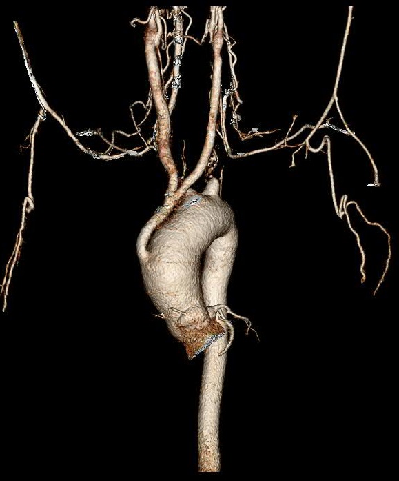 MayoVascSurgery's tweet photo. 28 year old woman with burned out stage 3 Takayasu's Arteritis refractory to medical management.  Ascending aorta to bilateral internal carotid bypass with reimplantation of dominant right vertebral artery. https://t.co/fJI7vJe8DO