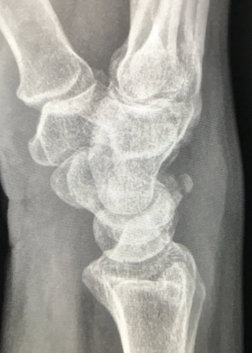 suzchongmd's tweet photo. Pooping 🦆 sign ➡️ triquetral fracture. Never gets old. #radiology #radres https://t.co/FummUyZILo
