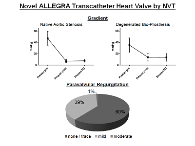 MyJSCAI's tweet photo. Novel self-expanding ALLEGRA #TAVR valve for native AS &amp; degenerated bioprostheses provides excellent hemodynamic results with a low complication rate.

https://t.co/vXKnkBJvJk

https://t.co/tfzJjZ1GFa, https://t.co/oEQYGH7lGw, https://t.co/1F87WjdBS3 https://t.co/FGEYLtVxJK