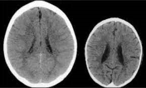 Praat praat over de gevolgen van kindermishandeling op de hersenen. Het brein is een netwerk van draadjes, dat groeit en ontwikkelt doordat er na elke ervaring aftakkingen worden gevormd. Bij kindermishandeling wordt die groei geblokkeerd en kunnen vaardigheden worden beperkt.