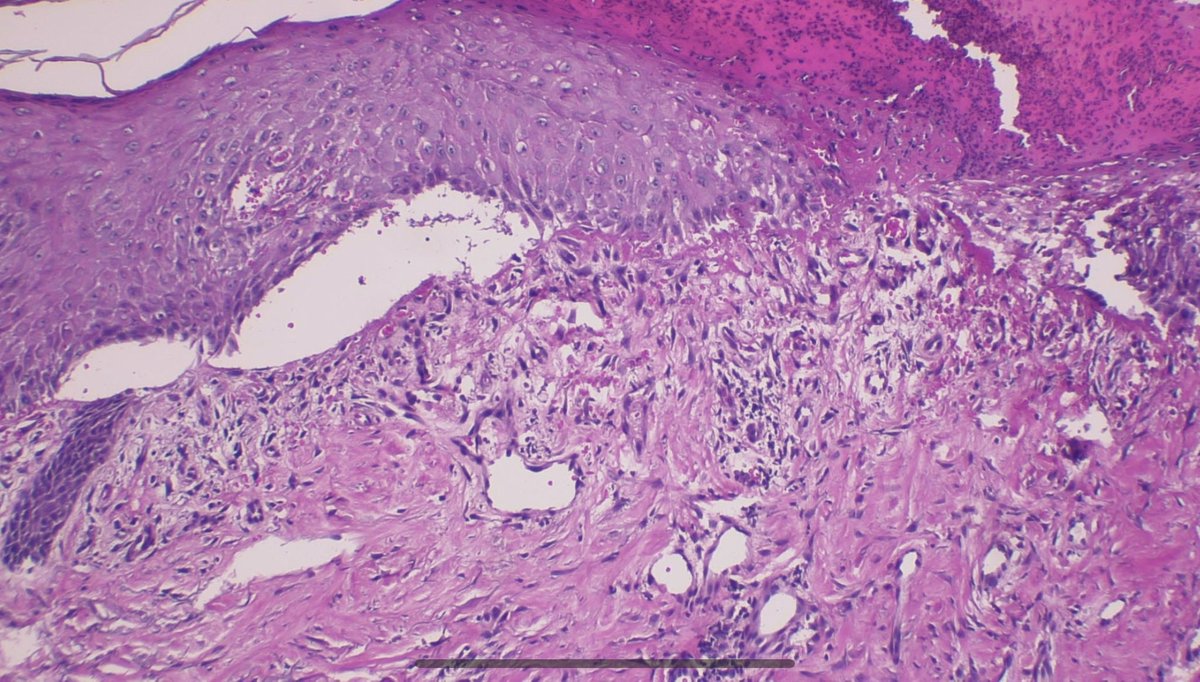 JCandidoXavier's tweet photo. Skin-picking disorder (factitial dermatitis).
HISTOLOGICAL TIPS:
1- subepidermal vesiculation, 
2- ulceration with crusts 
3- mild dermal inflammatory infiltrate despite the ulceration

#path #pathology #dermatology #dermpath #pathclues #surgpath #dermatitis #patología https://t.co/8GufZpS7Ea