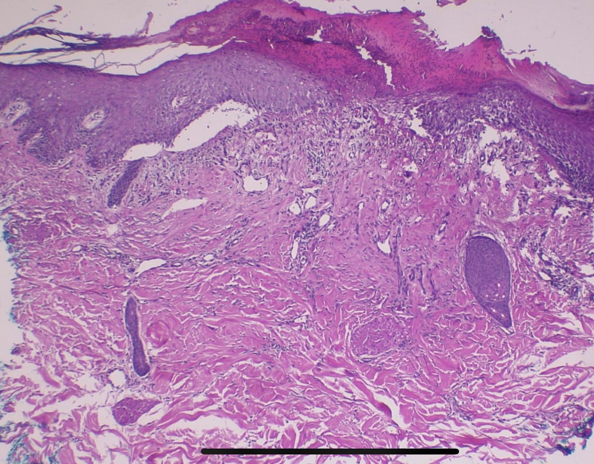 JCandidoXavier's tweet photo. Skin-picking disorder (factitial dermatitis).
HISTOLOGICAL TIPS:
1- subepidermal vesiculation, 
2- ulceration with crusts 
3- mild dermal inflammatory infiltrate despite the ulceration

#path #pathology #dermatology #dermpath #pathclues #surgpath #dermatitis #patología https://t.co/8GufZpS7Ea