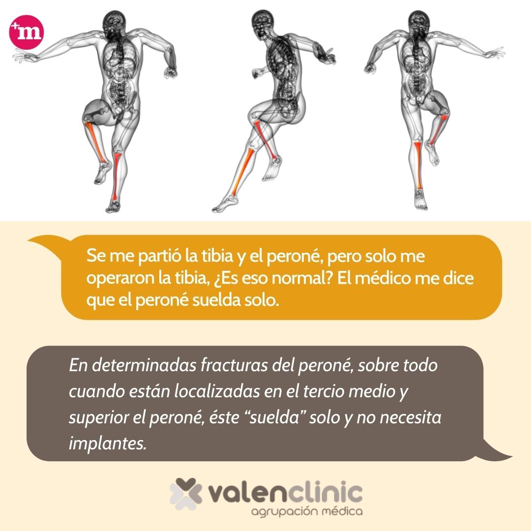 masquemedicos's tweet photo. "Se me partió la tibia y el peroné, pero solo me operaron la tibia, ¿Es eso normal? El médico me dice que el peroné suelda solo."

Responden desde @valenclinic 

https://t.co/cFSSbWfmfo https://t.co/4Eo3twXlig