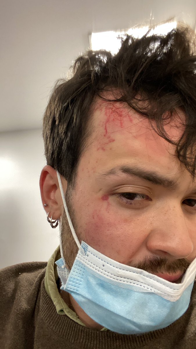 BTRafx's tweet photo. El miércoles pasado viví algo que no deseo a nadie, como los accidentes de tráfico, sabemos que pasa en la sociedad pero que nunca esperas que te pase a ti o a alguien cercano a ti. Bueno pues si, el miércoles por la noche sufrí una agresión homófoba que me dejó la cara así. https://t.co/VZ7snECD2x