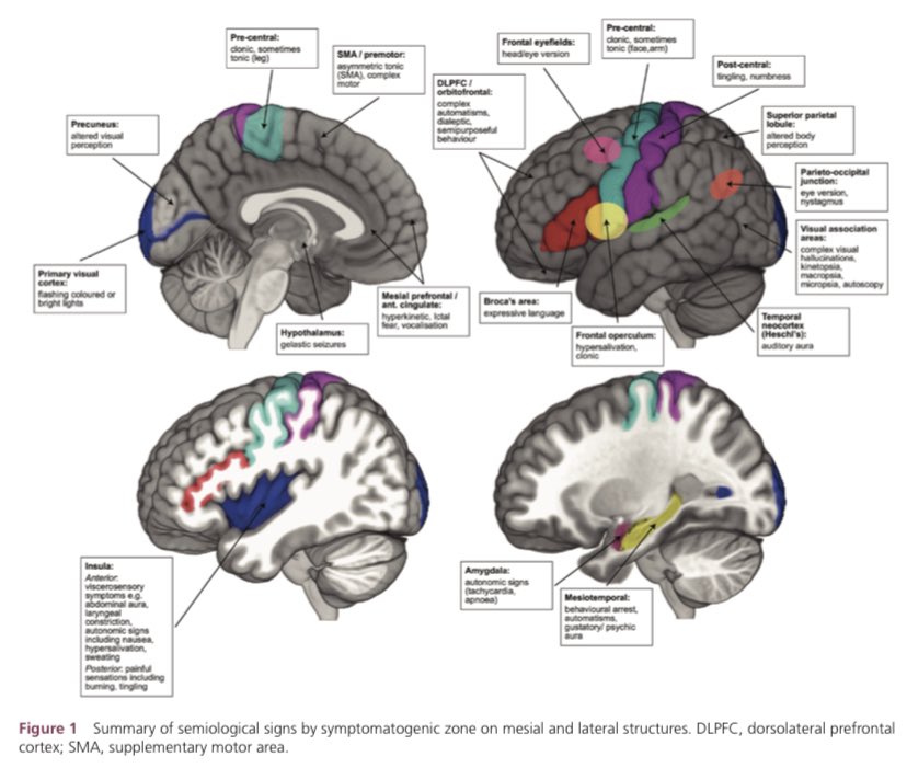 interneurona's tweet photo. Guía práctica sobre #localización en #epilepsia focal 

Vía @PracticalNeurol 
Y #gratis!! 
🆓
#openaccess 

@sesologia @g_fores_r @DavidMBEp @epileptologo @Epilepsibcn 

https://t.co/RDN9Plm5WR https://t.co/wfj3lA6mUJ