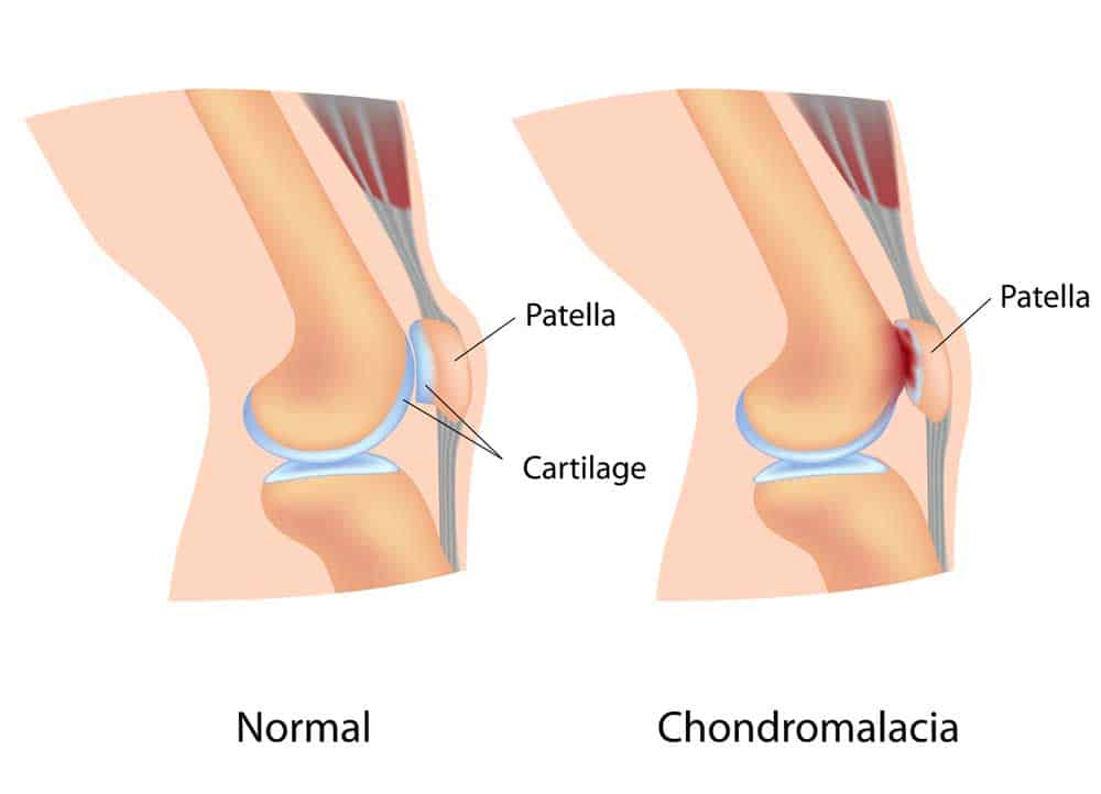 thekneedoc's tweet photo. What causes anterior #kneepain in adolescent females?

Here is a detailed breakdown of what you need to know. https://t.co/SsUqzMHJMY  #sportsmedicine #orthotwitter https://t.co/tbMSBeXeZB