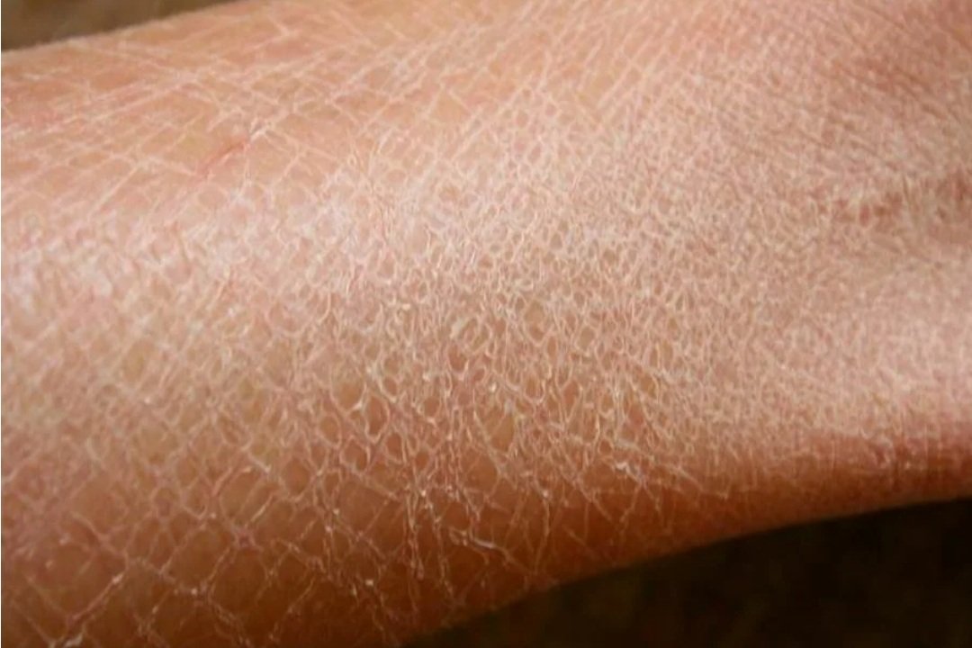 Сухость кожи человека. Сухость кожи человека. Сухая кожа эстетика. Сухая кожа картинки. Липидный матрикс.