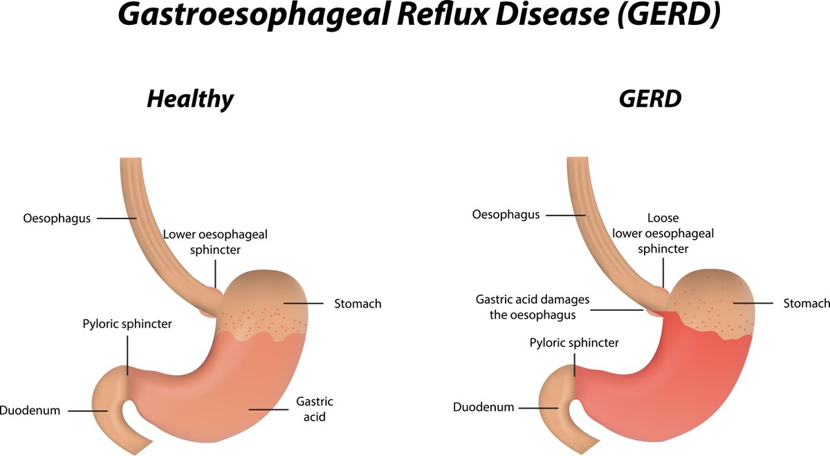 HealthierTucson's tweet photo. It's GERD (Gastroesophageal reflux disease) Awareness Week! GERD occurs when stomach acid frequently flows back into the tube connecting your mouth and stomach (esophagus). Curious if you have GERD? Find out the difference between GERD and Heartburn at: https://t.co/FWcpjXnDHn https://t.co/9KLd45FAr2