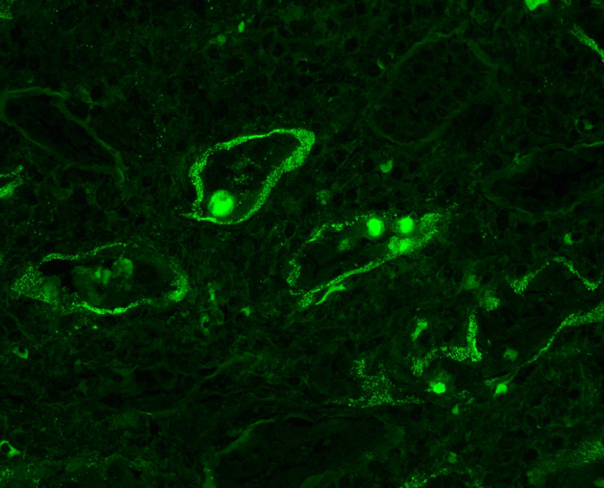 Impressive viral inclusions in this case of BK nephropathy. Some made it all the way to Bowman's capsule. Also prominent granular TBM deposits and nuclear staining with IgG. #renalpath #nephropath