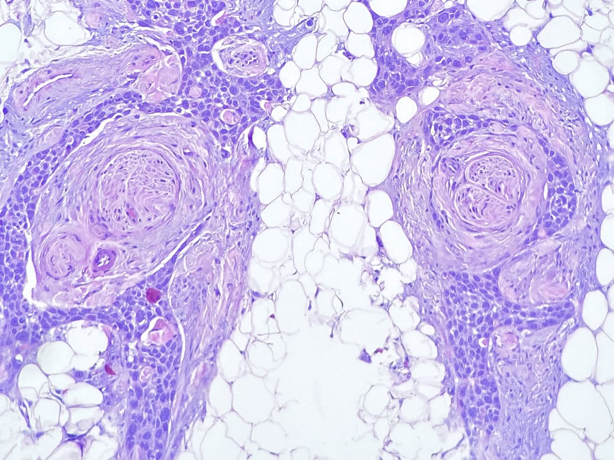DiegoMoralesN's tweet photo. This looks more like perineural “harassment” than perineural invasion. One of the nastiest squamous cell carcinomas I’ve ever seen. Context of immunosuppresion.
#dermtwitter #PathTwitter #dermpath https://t.co/55LmZdz3bI