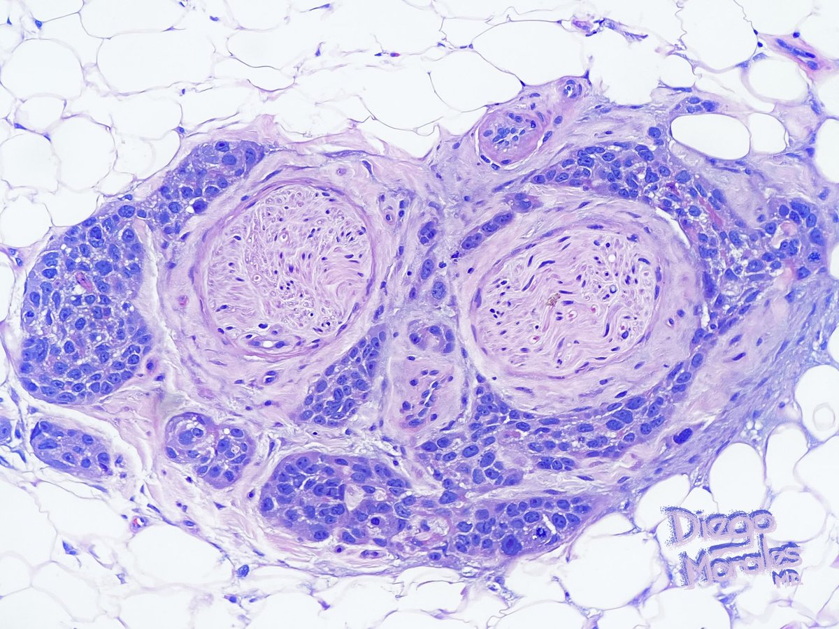 DiegoMoralesN's tweet photo. This looks more like perineural “harassment” than perineural invasion. One of the nastiest squamous cell carcinomas I’ve ever seen. Context of immunosuppresion.
#dermtwitter #PathTwitter #dermpath https://t.co/55LmZdz3bI