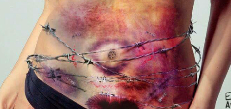 Endometriosis. 1 in 10 women have it. No one has heard of it. There is no proper treatment for it. They don't know what causes it. It takes 10 years to be diagnosed. The pain is like being carved from the inside. 

Sexism kept it from being properly researched. #sexmatters