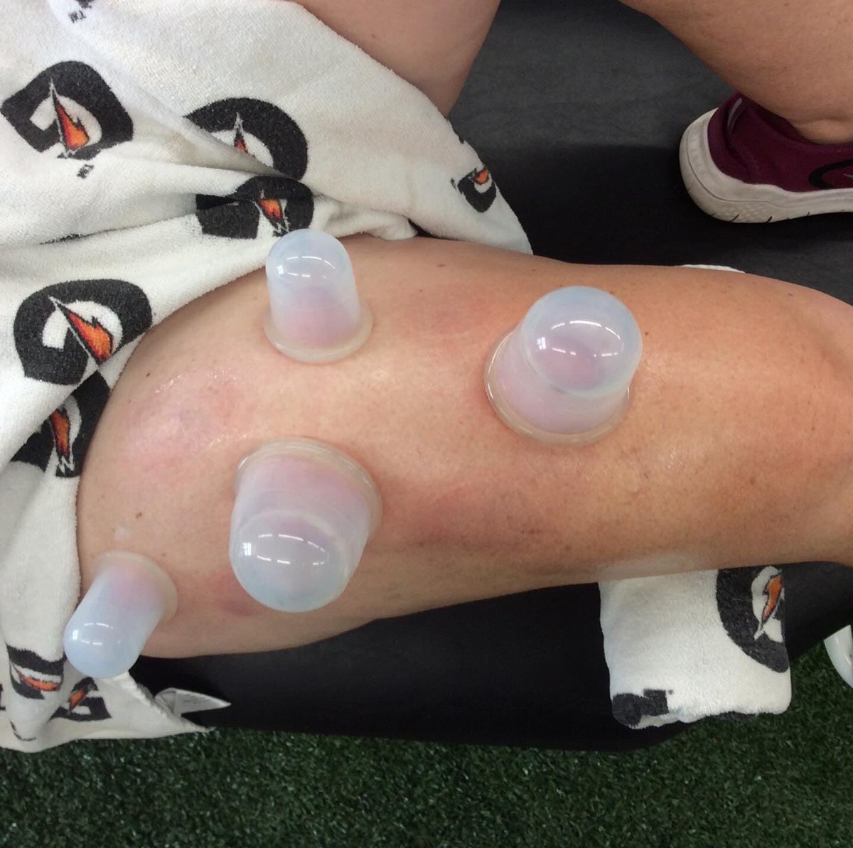 TrueSportsDL's tweet photo. Specialized Treatment options we offer at TSP:
-Dry Needling
-Deep Oscillation
-Graston Technique
-Cupping
We are your solution for SPORTS REHABILITATION.
Schedule an appointment at:
https://t.co/2zd3uhYTd6
#dryneedling #deeposcillation #GrastonTechnique #cupping https://t.co/JKUNAqoVUR