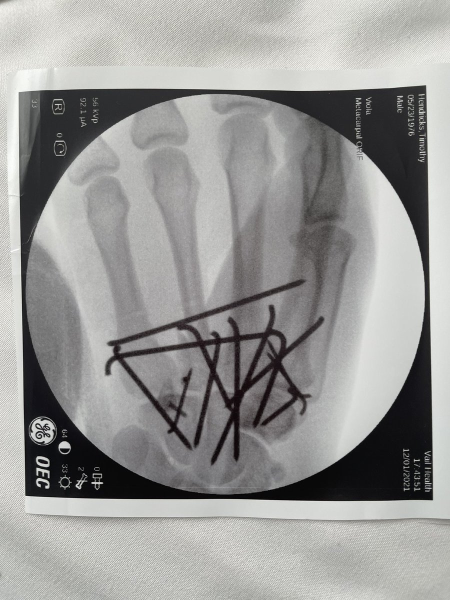 Saltwatertattoo's tweet photo. One day in a California ER, nine days in Colorado, two surgeries back to back, about thirteen pins, a shitload of sutures and my hand is back together, and I’m home. I was an emotional mess when I walked through the front door and hugged my wife and kids. https://t.co/u9ptHhO2CR