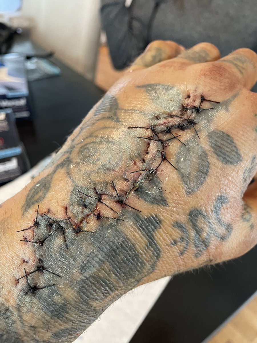Saltwatertattoo's tweet photo. One day in a California ER, nine days in Colorado, two surgeries back to back, about thirteen pins, a shitload of sutures and my hand is back together, and I’m home. I was an emotional mess when I walked through the front door and hugged my wife and kids. https://t.co/u9ptHhO2CR