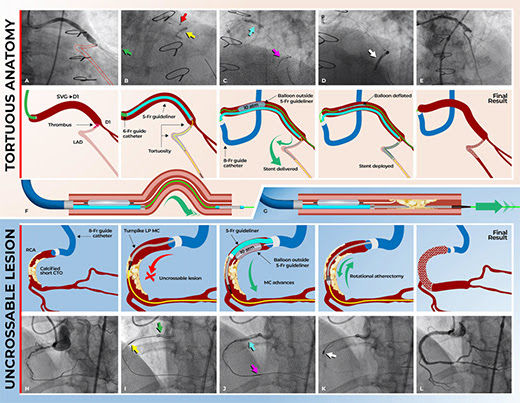 gbiondizoccai's tweet photo. The guide extension tunnel in landslide technique (TILT) for equipment delivery in severely tortuous or uncrossable lesions during percutaneous coronary intervention
https://t.co/UQITGQhvGo https://t.co/JWHcHtYwZ8