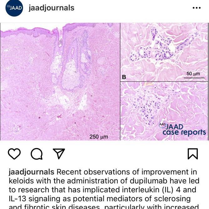 DrJJPereyra's tweet photo. Mejoría de #queloides con #Dupilumab subcutáneo. De momento solo series de casos. Hay en marcha un ensayo clínico 👉 https://t.co/sPxfBxjLGS https://t.co/p6Fr6z1aSt