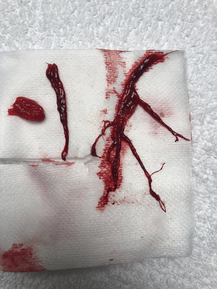 Nak_ravi's tweet photo. Who knew this clot would steer me towards Interventional Pulmonology! @AAB_IP Canβt wait for July 2022. #Interventionalpulm #bronch https://t.co/S4YCbYJb2p