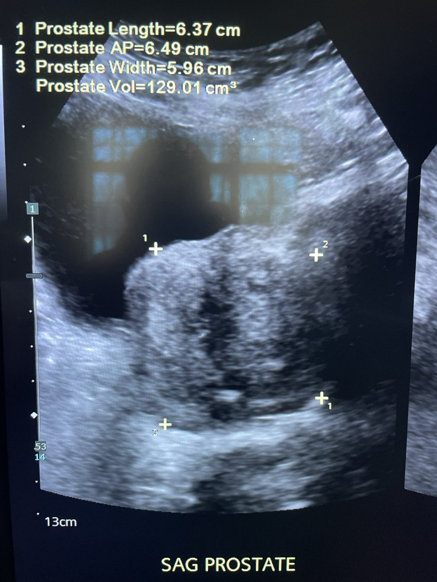 drochohan's tweet photo. When nocturia wakes you up but also your spouse, PAE can help both sleep peacefully. From 7 episodes a night to 1. Gland 130cc to 70cc in one month! @SIR_ECS @SIRRFS @SIRspecialists @UsaProstate https://t.co/gb93Mg1IOm