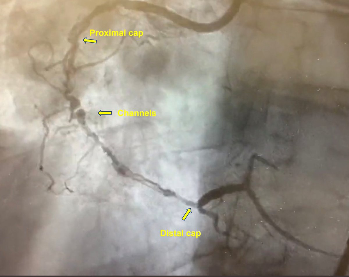 A follow-up, a mini-tweetorial on bridging in #CTO #PCI (would love to learn from opinions).
Both cases had well-developed channels (let's call them channels here) that provide antegrade flow. It is easier to find the caps in the first case (1/14)
#cardiotwitter #PCIcase #CTO101
