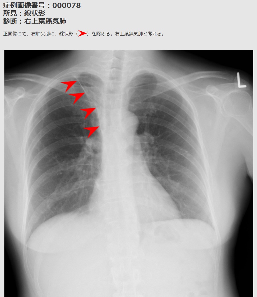 Twitter 上的 メディカル指南車 画像診断 一問一答 正解は 右肺尖部 です 46歳女性の右上葉無気肺の症例です メディカル指南車ではオンラインで画像診断を学ぶことができる 画像診断ナレッジサービス を App Storeでも配信を開始しました T Co