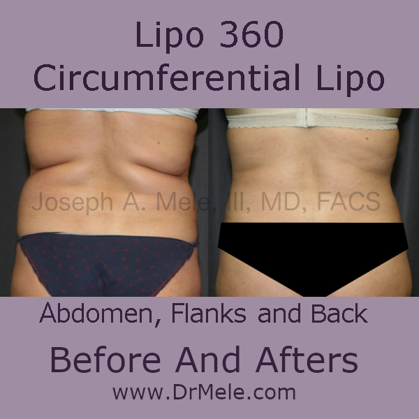 Dr. Mele on X: What is Lipo 360? If you are researching