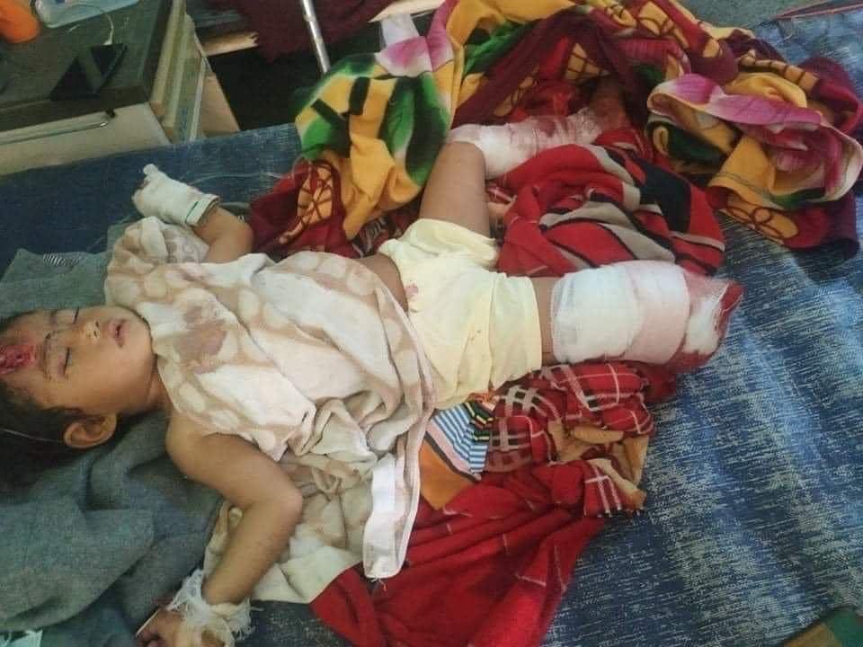 TheChindwin's tweet photo. Naing Leng, aged 2 years old has lost her right leg and badly injured as seen in the picture when the bomb planted by Myanmar’s military junta exploded in front of their house in #Mindat ,#Chin State.
Naing  Leng’s mother Hung Awi was killed on the spot in a bomb blast yesterday. https://t.co/XYRXK6RlJl