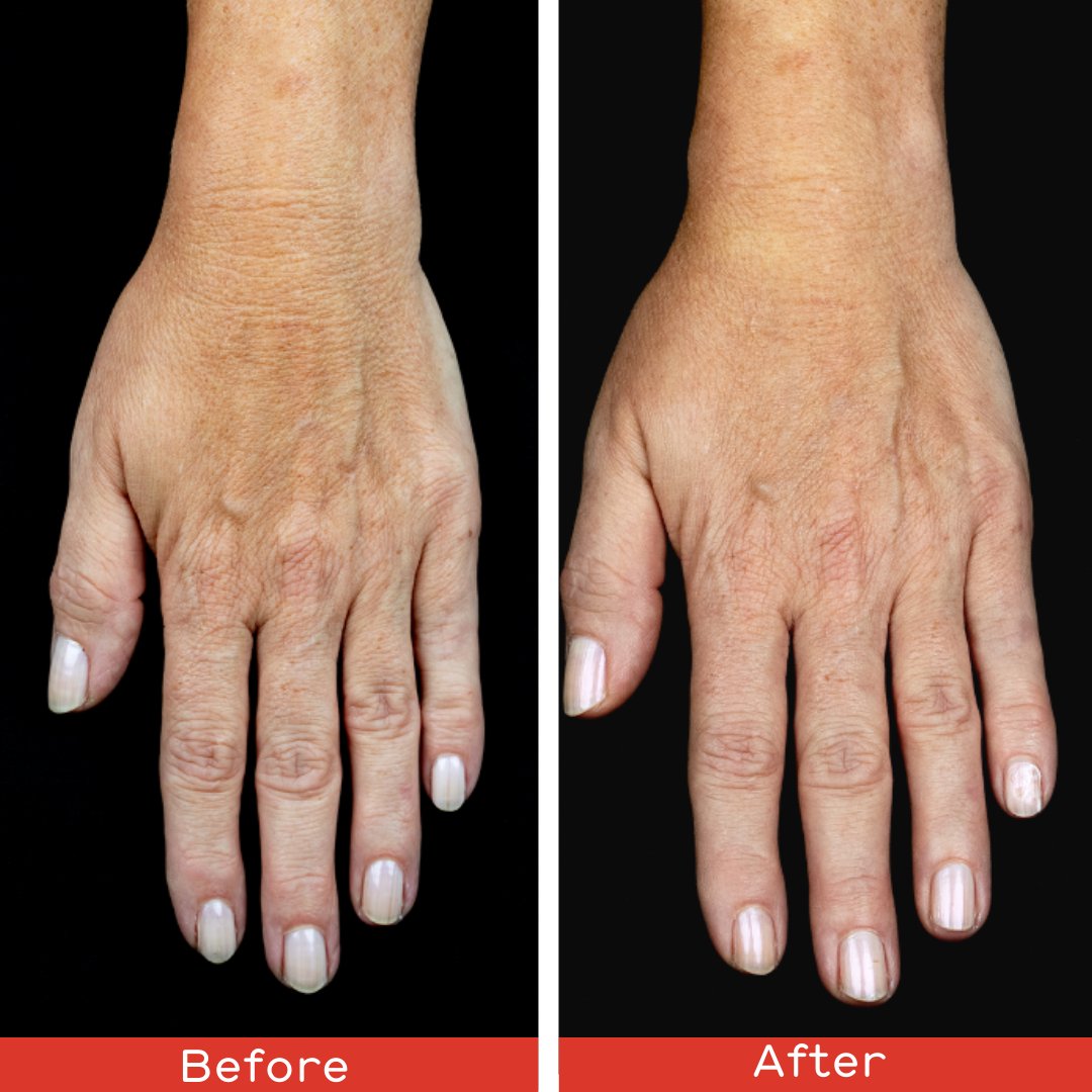 CromaPharmaUk's tweet photo. Have you heard about our latest innovation, juvenus?
#juvenus is an injectable skin booster that helps restructure and rejuvenate the skin based on PDRN technology. 
Look at the fantastic results!
Please contact your local sales rep for more information or to place an order. https://t.co/keR2vC9T8k