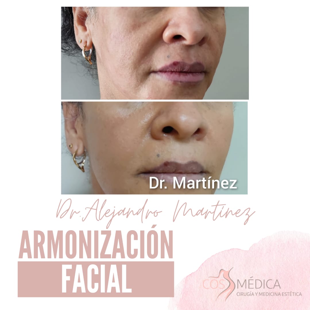 #ARMONIZACIÓNFACIAL​
En este caso teníamos claro nuestro objetivo: destacar la belleza natural de nuestra paciente a través de pequeñas modificaciones en su fisionomía facial, realzando los puntos fuertes y suavizando las imperfecciones.​ ¿Qué te parece el resultado? ¡Te leemos!