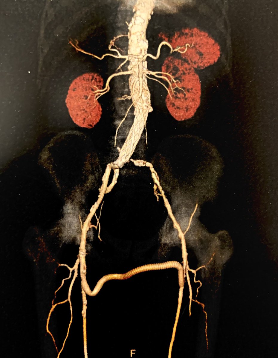 lbncbma's tweet photo. Solução Clássica, Simples e Eficiente.
Ponte Femoro-Femoral Cruzada com Endoprotese Monoilíaca. #PTA #endovascularsurgery #criticallimbIschemia #thinkaorta  #medtwitter #surgicalbypass
#aneurysm #practicemakesperfect #vasculartraining #revascularization #amputationprevention https://t.co/nphQf3p7E9