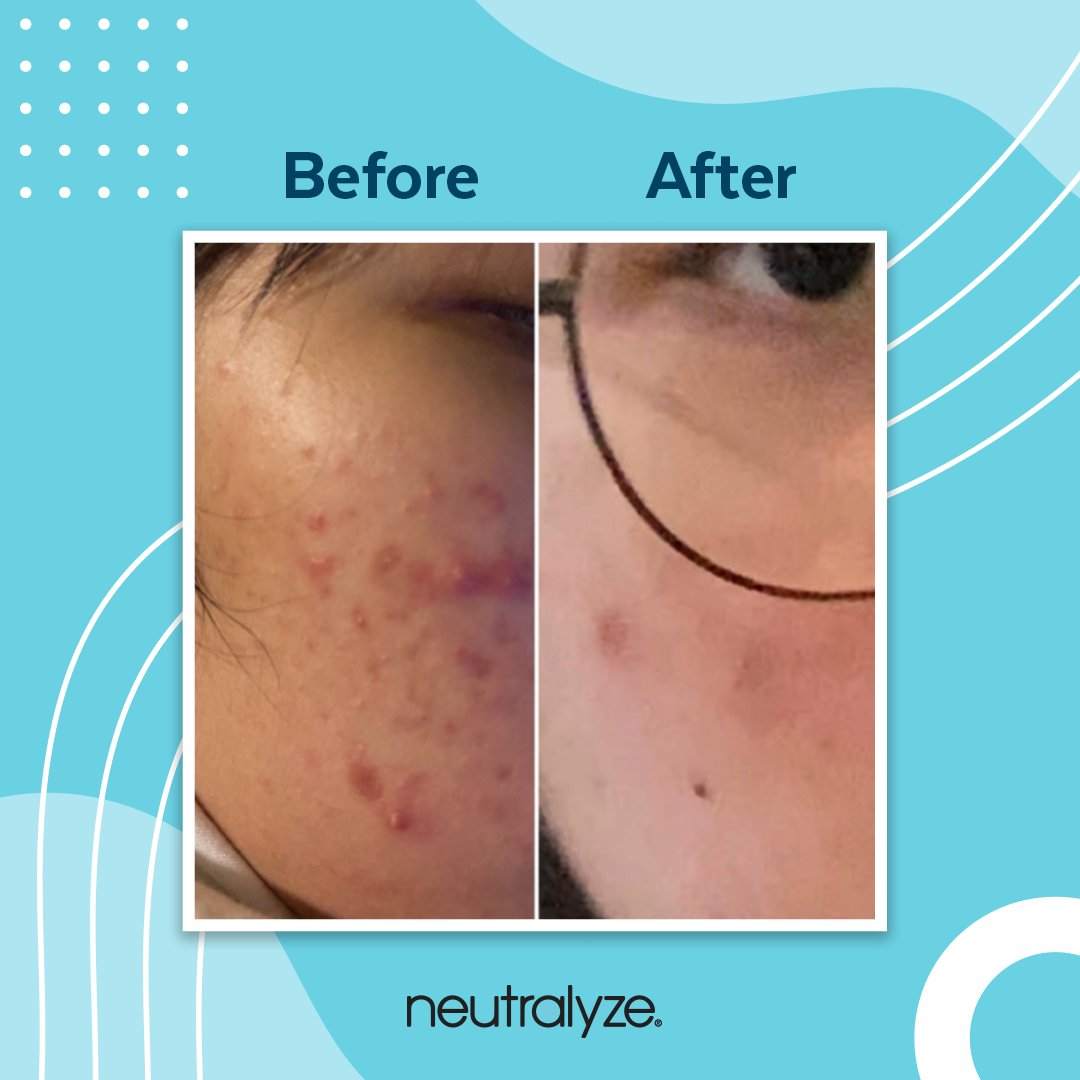 neutralyzeacne's tweet photo. Combatting & clearing acne one day at a time 👊👊
#neutralyze #acne #acnebreakouts #acneskincare #acnetreatment #acnecommunity #myacneskin #acnetips #amazonfinds https://t.co/z7pUvhP5Xp