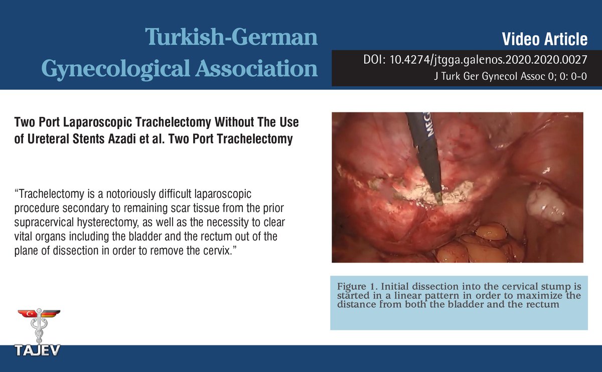 JtggaOfficial's tweet photo. Two port laparoscopic trachelectomy without the use of ureteral stents Azadi et al. Two port trachelectomy
Here: https://t.co/DR90peZ2Tt
#Trachelectomy #Laparoscopy
#MinimallyInvasiveSurgery #Marchand #MarchandInstitute #UterineCervix #Cervix #RemovalOfCervix https://t.co/3LUK4im6cs