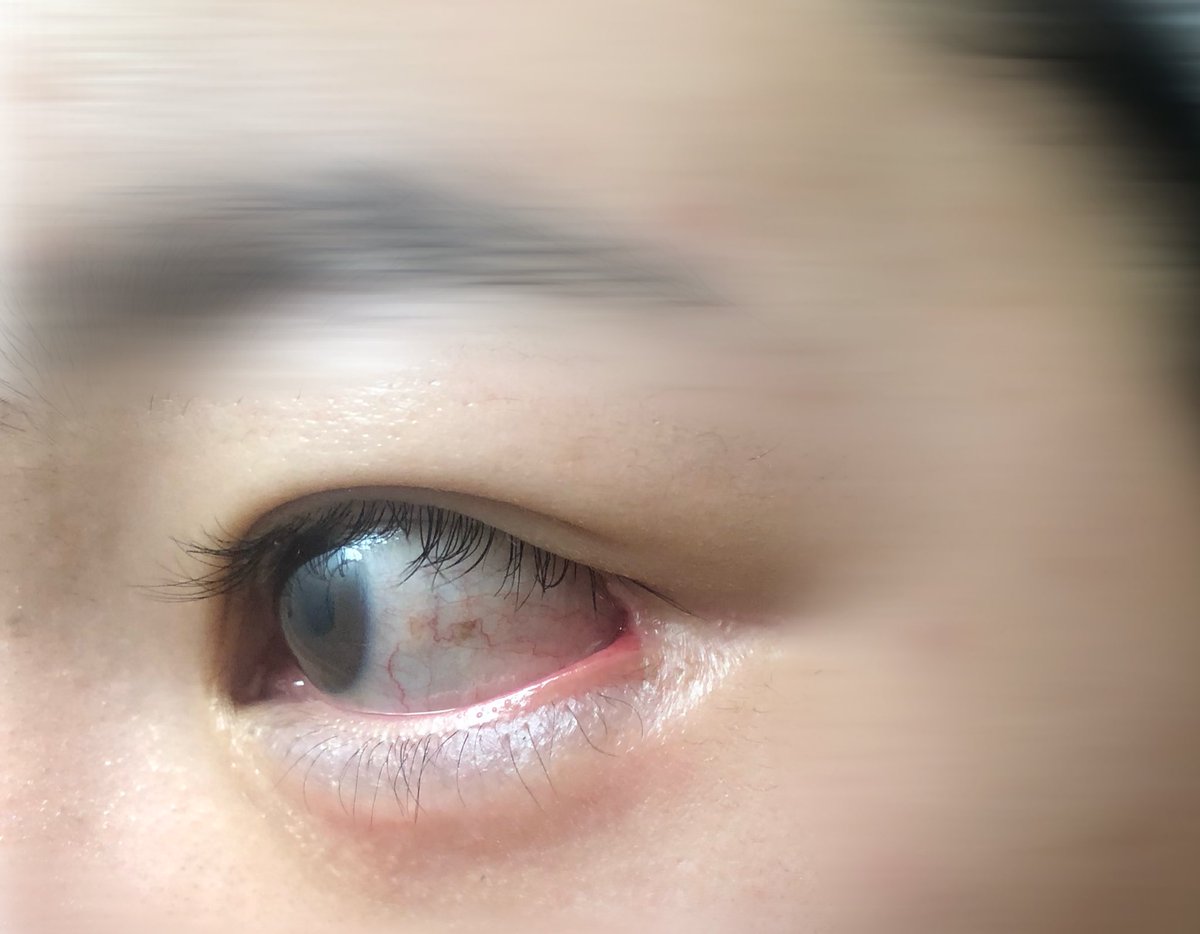 目尻切開修正before。
目尻の靭帯が変なとこに留められてるっぽくてかなり不自然。

今回、靭帯の癒着を剥がして留め直してもらったんだけど、チークリフトで留めたとこも外されてるようや気がしてちょっと病んでる。。