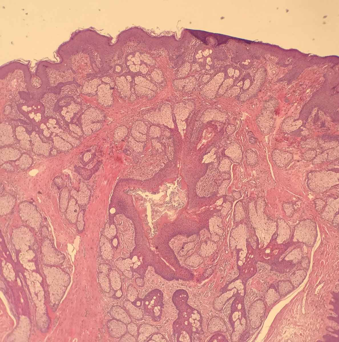 jennagregory488's tweet photo. Male (51) with a papillomatous lesion on nipple. Folliculosebaceous hamartoma (SMA highlights the smooth muscle proliferation). Not seen one of these at this site before so thought that I would share 🥰 #dermpath #skinpathology #dermatology #pathtwitter https://t.co/bjYIjmLLh5