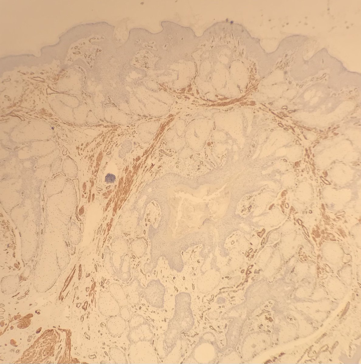 jennagregory488's tweet photo. Male (51) with a papillomatous lesion on nipple. Folliculosebaceous hamartoma (SMA highlights the smooth muscle proliferation). Not seen one of these at this site before so thought that I would share 🥰 #dermpath #skinpathology #dermatology #pathtwitter https://t.co/bjYIjmLLh5