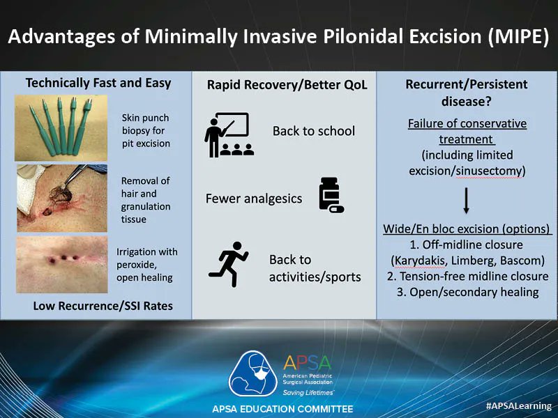 Check out this visual abstract that explains the advantages of trephination for pilonidal disease. #APSALearning