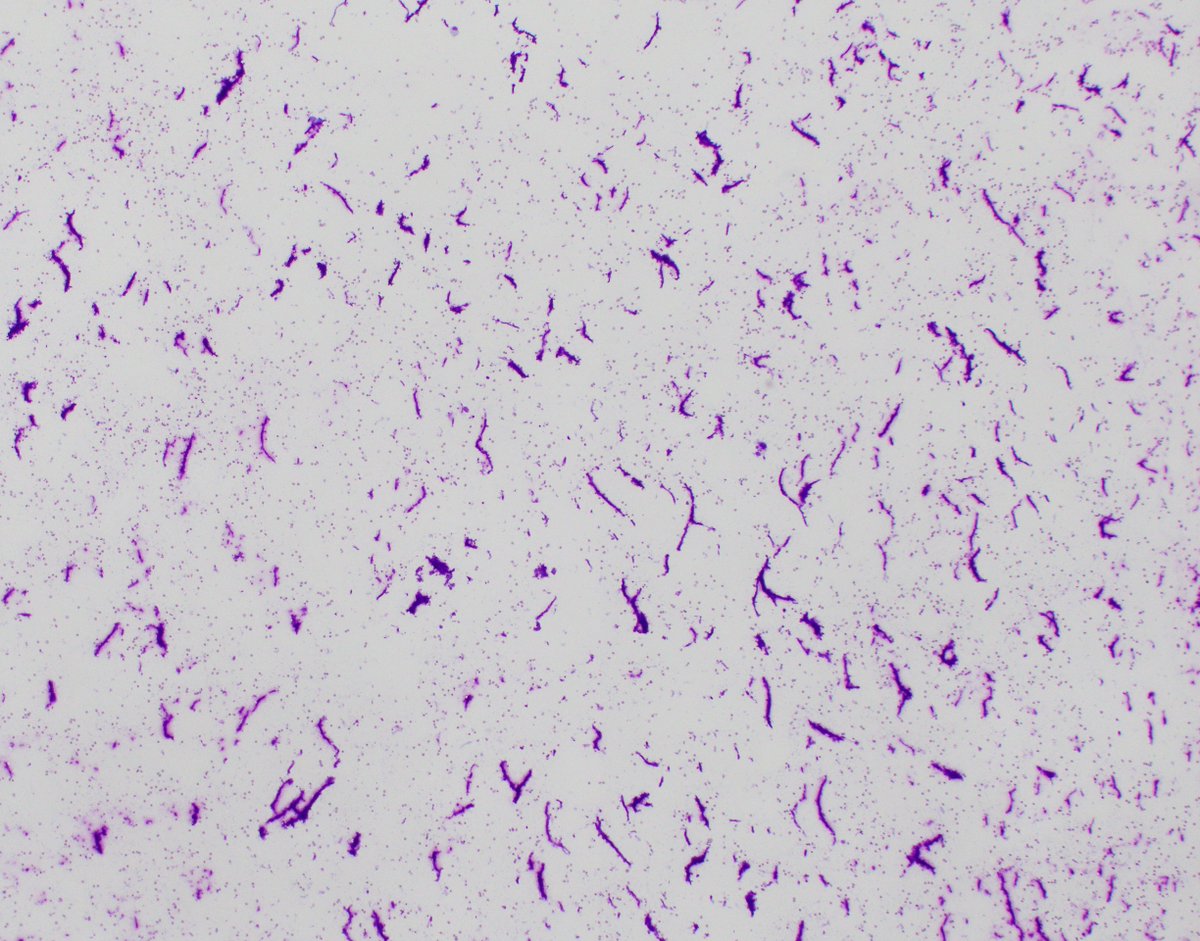 HubertLauMD's tweet image. How would you describe this pattern of necrosis on an #FNApath #CytoPath smear?

I always thought it looked like a bunch of worms🪱.

Histologic correlate in third picture.
