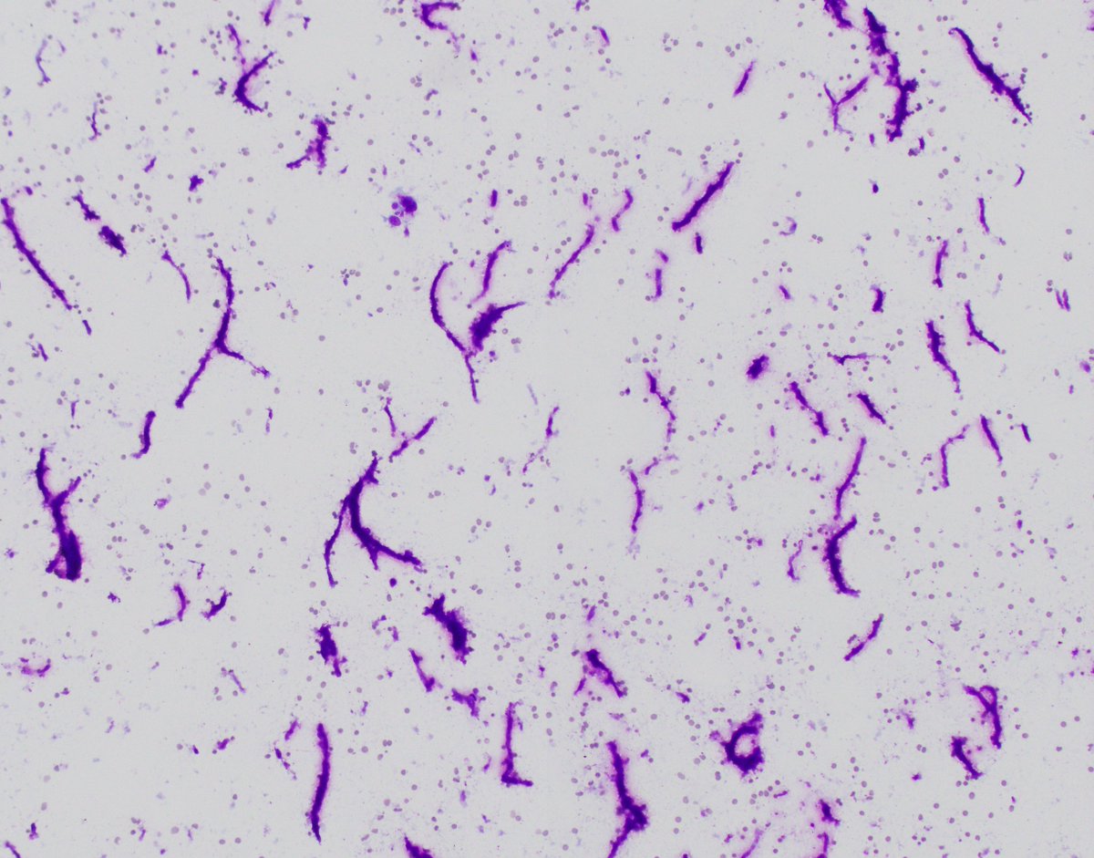 HubertLauMD's tweet image. How would you describe this pattern of necrosis on an #FNApath #CytoPath smear?

I always thought it looked like a bunch of worms🪱.

Histologic correlate in third picture.