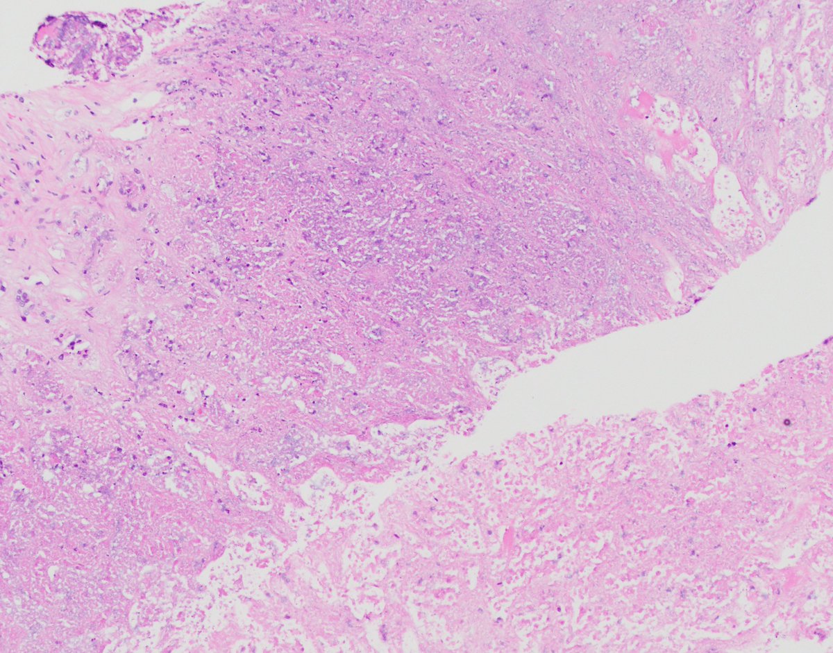HubertLauMD's tweet image. How would you describe this pattern of necrosis on an #FNApath #CytoPath smear?

I always thought it looked like a bunch of worms🪱.

Histologic correlate in third picture.