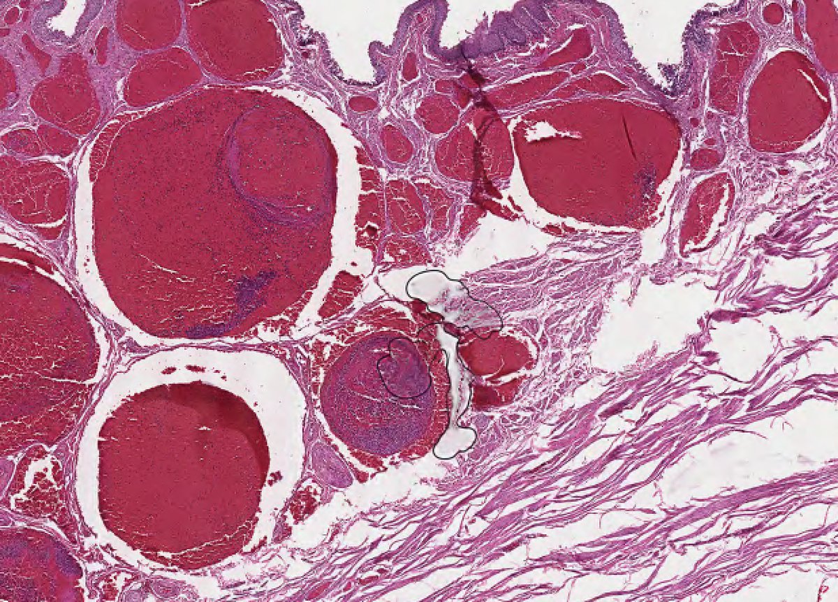 HistologyHome's tweet photo. Thanks for sticking around for another week! This week’s #PathCorrelate is Hemorrhoids. These are dilated mucosal and submucosal veins found in the anal canal.
15/16 https://t.co/tWnyXHwfF0