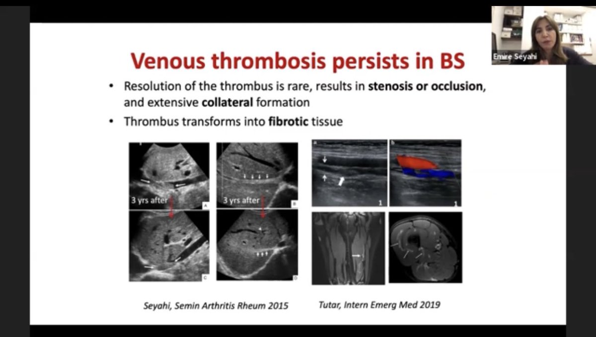 AshimaMakol's tweet photo. ✨ Phenomenal review of #Behcet’s by Dr. Seyahi #IRACON21 

For Venous/Arterial Thrombosis
🎯 Immunesuppression is KEY! 👉 Anti-TNF 1st
🎯 Anticoag controversial but added if 
      👉 Low bleeding risk
      👉 NO Pulmonary Artery aneurysm 
      👉 DOACs may be reasonable https://t.co/lqXxzqhI7Y