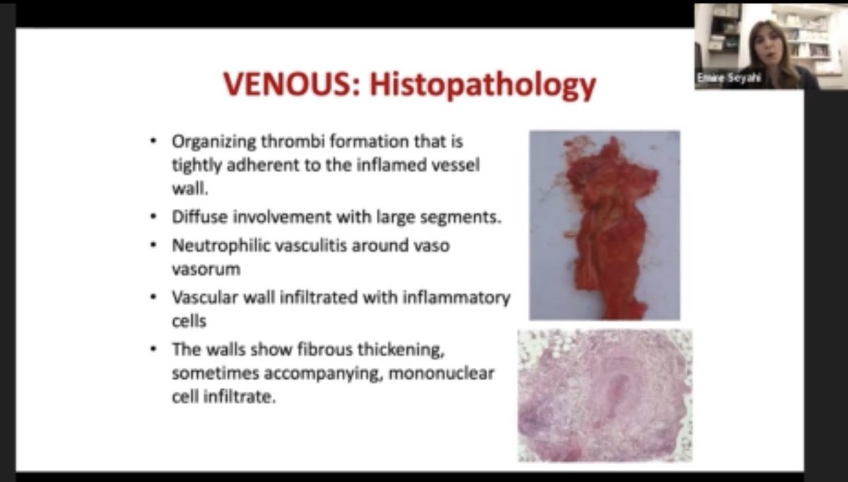AshimaMakol's tweet photo. ✨ Phenomenal review of #Behcet’s by Dr. Seyahi #IRACON21 

For Venous/Arterial Thrombosis
🎯 Immunesuppression is KEY! 👉 Anti-TNF 1st
🎯 Anticoag controversial but added if 
      👉 Low bleeding risk
      👉 NO Pulmonary Artery aneurysm 
      👉 DOACs may be reasonable https://t.co/lqXxzqhI7Y